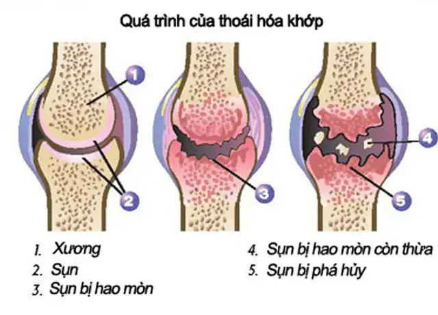 BẠN BÈ CÙNG TUỔI ĐÃ ĐI ĐIỀU TRỊ THOÁI HÓA KHỚP