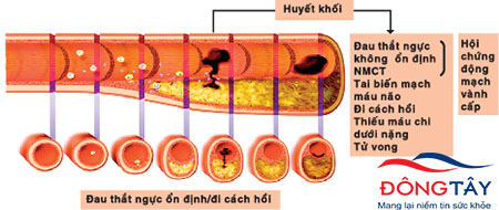 Kháng đông trong hội chứng vành cấp