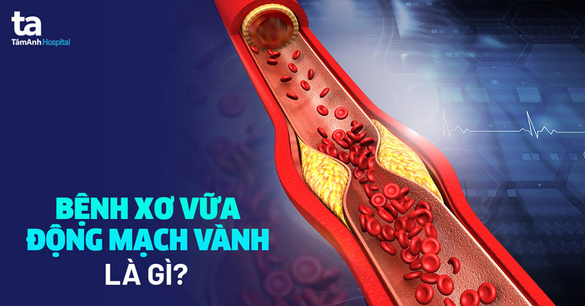 Đau thắt ngực: Nguyên nhân, dấu hiệu và phương pháp điều trị mới nhất