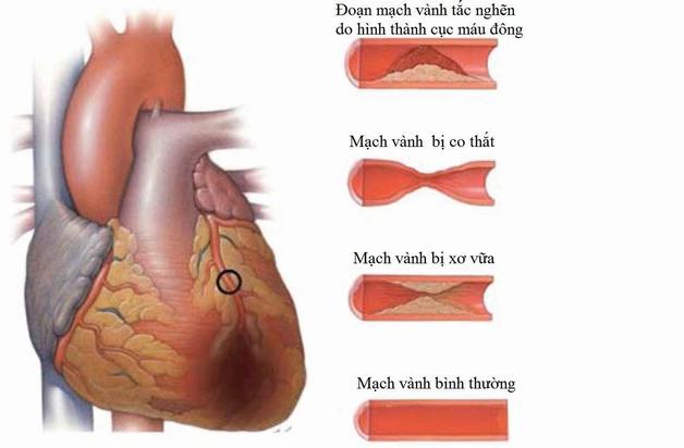 Hình ảnh minh họa động mạch vành bị co thắt làm giảm lưu lượng máu đến tim