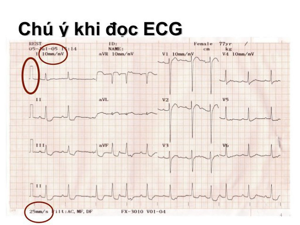 Máy điện tâm đồ ECG là một công cụ không thể thiếu trong việc chẩn đoán rối loạn nhịp tim