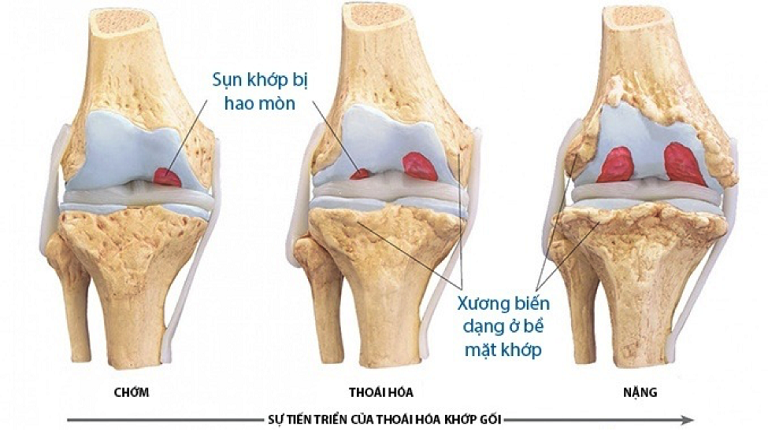 PRP điều trị thoái hóa khớp gối: Hiệu quả thực tế thế nào?