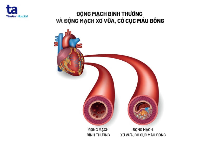 Đột quỵ: Nhận biết sớm dấu hiệu vàng để cứu sống người thân